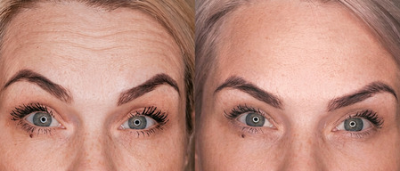 ботокс диспорт в Томске