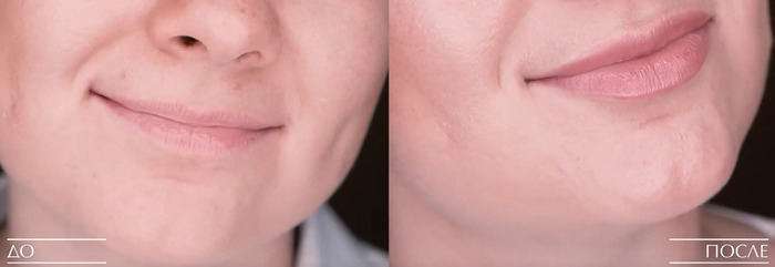 филлеры увеличение губ в Томске