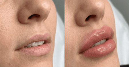 увеличение губ филлером косметологом в Томске 
