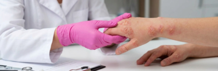 Атопический дерматит лечение в Томске 