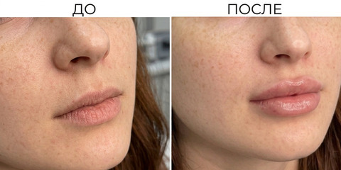 губы после увеличения косметологом в Томске