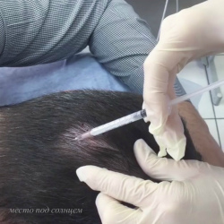 Процедуры против выпадения волос у мужчин