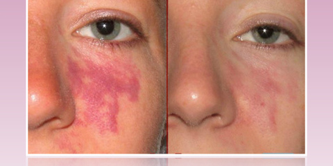 Удаления винных пятен и гемангиом