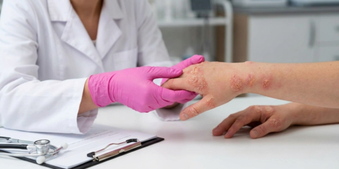 Дерматит, сухость кистей рук