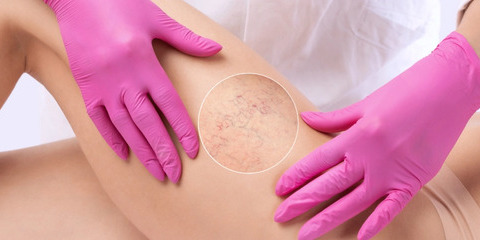Удаление сосудов Laser Vascular